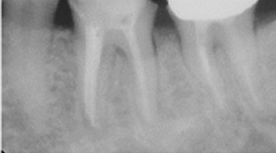 歯髄炎・根尖性歯周炎のニッケルチタンファイルによる治療例（施術後）