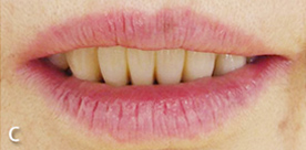 歯と唇の分析（C）