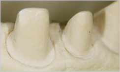 精密な歯の形成と印象