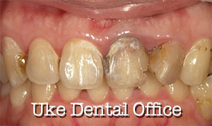 歯周病・虫歯・変色のための審美歯科治療例（施術前）