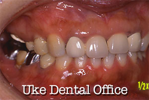 審美歯科の長期経過症例（施術前）