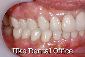 審美歯科の長期経過症例（施術後）