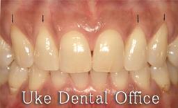 歯周整形治療（歯肉移植）の症例写真