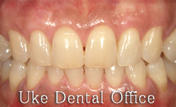 歯周整形治療（歯肉移植）の症例写真