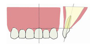 健康な歯の正面・断面図