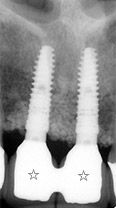 骨再生療法、歯肉移植を伴うインプラント治療例①（インプラント部分拡大）