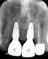 骨再生療法、歯肉移植を伴うインプラント治療例②（インプラント部分拡大）