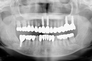 骨再生療法、歯肉移植を伴うインプラント治療例③（インプラント部分詳細）