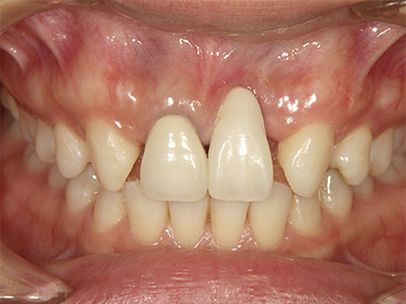 長くなってしまった歯の症例