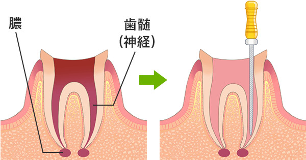 根管治療の流れ（細菌感染した歯の神経組織を除去）