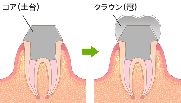 根管治療の流れ（コアという土台にクラウンと呼ばれる歯の被せ物を装着）