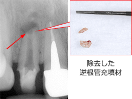 根尖性歯周炎のMTAセメントを用いた根管治療例⑧（充填剤除去）