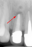 根尖性歯周炎のMTAセメントを用いた根管治療例⑥（施術後）