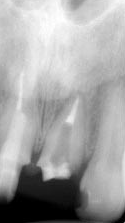 根尖性歯周炎のMTAセメントを用いた根管治療例②（施術後）