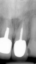 根尖性歯周炎のMTAセメントを用いた根管治療例⑦（施術前）