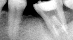根尖性歯周炎のMTAセメントを用いた根管治療例③（施術後）