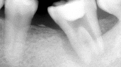 根尖性歯周炎のMTAセメントを用いた根管治療例⑩（施術前）