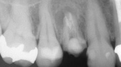根尖性歯周炎のMTAセメントを用いた根管治療例④（施術後）