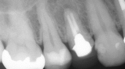 根尖性歯周炎のMTAセメントを用いた根管治療例④（施術前）