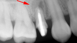 根尖性歯周炎のMTAセメントを用いた根管治療例⑩（施術前）