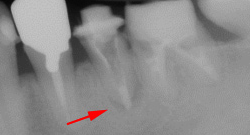 根尖性歯周炎のMTAセメントを用いた根管治療例11（施術前）