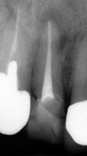 歯冠破折・根尖性歯周炎の治療例（施術後）