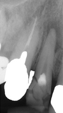 歯冠破折・根尖性歯周炎の治療例（施術前）