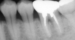 根尖性歯周炎のMTAセメントを用いた根管治療例⑳（施術前）