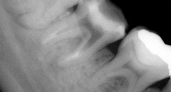 根尖性歯周炎のMTAセメントを用いた根管治療例⑭（施術後）