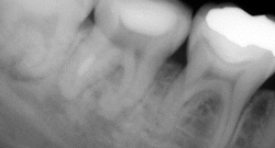 根尖性歯周炎のMTAセメントを用いた根管治療例12（施術前）