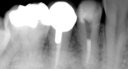 根尖性歯周炎のMTAセメントを用いた根管治療例13（施術後）