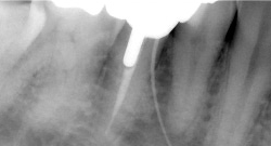 根尖性歯周炎のMTAセメントを用いた根管治療例⑧（施術前）