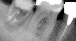 根尖性歯周炎のMTAセメントを用いた根管治療例14（施術後）