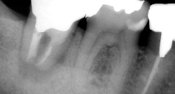 根尖性歯周炎のMTAセメントを用いた根管治療例⑯（施術前）