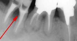 根尖性歯周炎のMTAセメントを用いた根管治療例⑰（施術後）