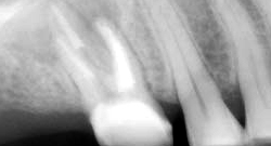 根尖性歯周炎のMTAセメントを用いた根管治療例⑱（施術後）