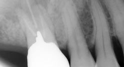 根尖性歯周炎のMTAセメントを用いた根管治療例⑪（施術前）