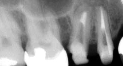 根尖性歯周炎のMTAセメントを用いた根管治療例17（施術後）