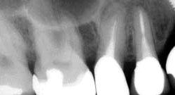 根尖性歯周炎のMTAセメントを用いた根管治療例17（施術前）