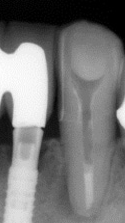 根尖性歯周炎のMTAセメントを用いた根管治療例19（根充後）