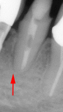 根尖性歯周炎のMTAセメントを用いた根管治療例㉑（施術後）