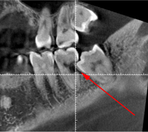 歯髄炎のMTAセメントを用いた根管治療例（施術前、CT）