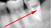 歯髄炎のMTAセメントを用いた根管治療例（根充後）