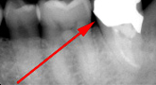 歯髄炎のMTAセメントを用いた根管治療例（施術後）