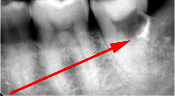 歯髄炎のMTAセメントを用いた根管治療例（施術前）