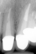 根尖性歯周炎のMTAセメントを用いた根管治療例②（術後2年-1）