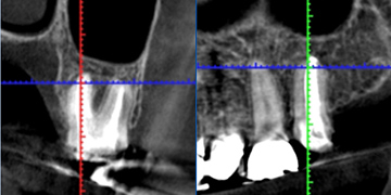 根尖性歯周炎のMTAセメントを用いた根管治療例⑤（術後3ヶ月）