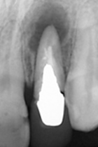 根尖性歯周炎のMTAセメントを用いた根管治療例⑥（術前1）