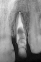 根尖性歯周炎のMTAセメントを用いた根管治療例⑥（術後2年-1）
