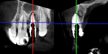 根尖性歯周炎のMTAセメントを用いた根管治療例⑥（術後2年-2）
